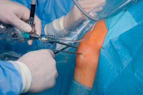 artroscopia de rodilla y hombros artroscopia de rodilla y hombros